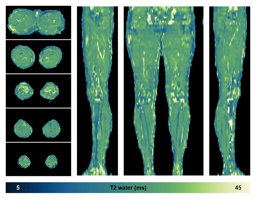 The water only T2 relaxation time of the lower extremity obtained from multi echo spin echo t2 mapping with EPG based reconstruction.